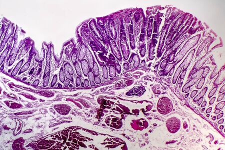 Villous colon adenocarcinoma, light micrograph, photo under microscopeの写真素材