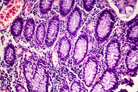 Poorly differentiated intestinal adenocarcinoma, light micrograph, photo under microscopeの写真素材