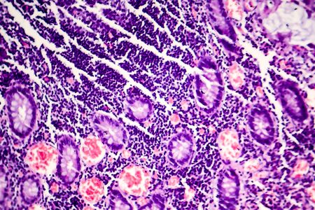 Poorly differentiated intestinal adenocarcinoma, light micrograph, photo under microscopeの写真素材