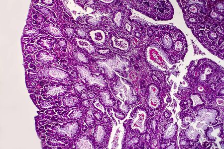 Villous colon adenocarcinoma, light micrograph, photo under microscopeの写真素材