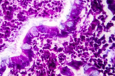 Villous colon adenocarcinoma, light micrograph, photo under microscope. High magnification