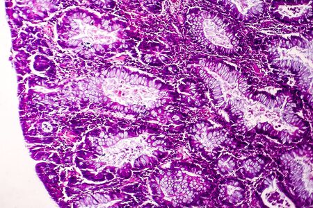Villous colon adenocarcinoma, light micrograph, photo under microscopeの写真素材