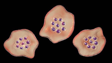 The malaria-infected red blood cell. 3D illustration showing malaria parasite Plasmodium ovale in...