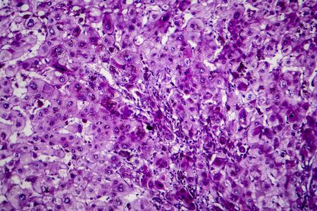 Histopathology of alcoholic hepatitis, light micrograph, photo under microscopeの写真素材