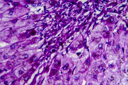 Histopathology of alcoholic hepatitis, light micrograph, photo under microscope. High magnificationの写真素材