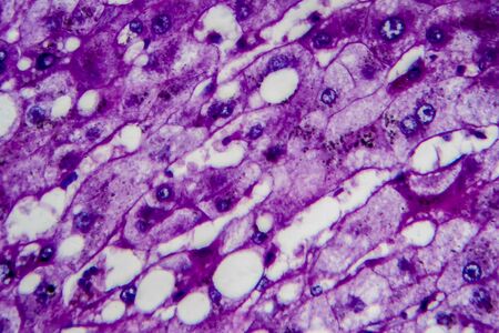 Histopathology of alcoholic hepatitis, light micrograph, photo under microscope. High magnificationの写真素材