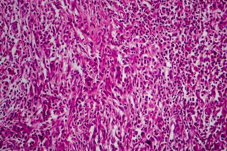 Non-Hodgkins lymphoma, light micrograph, photo under microscopeの写真素材