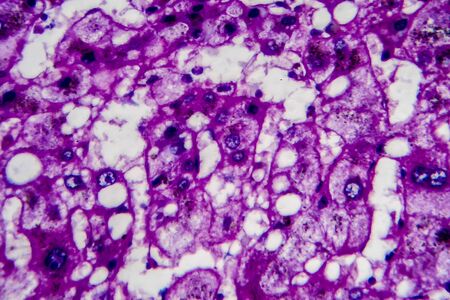 Histopathology of alcoholic hepatitis, light micrograph, photo under microscope. High magnificationの写真素材