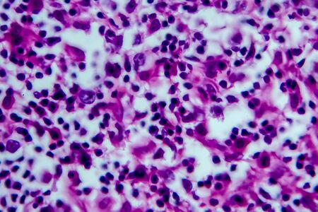 Hodgkin's lymphoma, light micrograph, photo under microscope. High magnificationの写真素材
