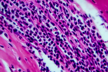 Hodgkins lymphoma, light micrograph, photo under microscope. High magnificationの写真素材