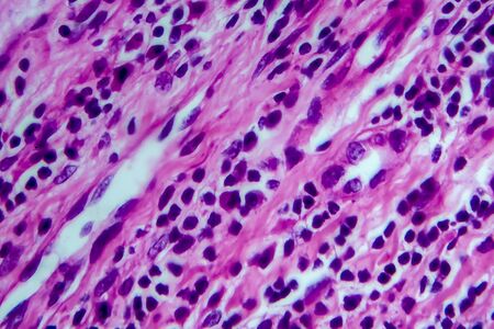 Hodgkins lymphoma, light micrograph, photo under microscope. High magnificationの写真素材