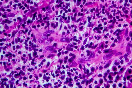Hodgkins lymphoma, light micrograph, photo under microscope. High magnificationの写真素材