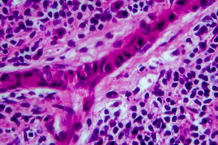 Hodgkin's lymphoma, light micrograph, photo under microscope. High magnificationの写真素材