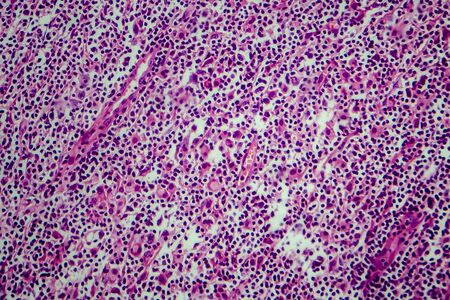Hodgkin's lymphoma, light micrograph, photo under microscopeの写真素材