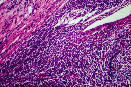 Hodgkins lymphoma, light micrograph, photo under microscopeの写真素材