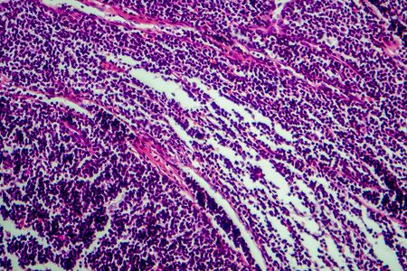 Hodgkin's lymphoma, light micrograph, photo under microscope