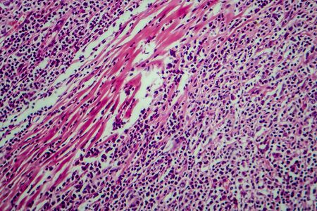 Hodgkins lymphoma, light micrograph, photo under microscopeの写真素材