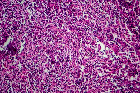 Hodgkins lymphoma, light micrograph, photo under microscopeの写真素材