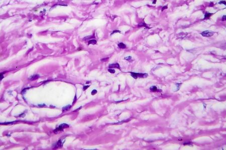 Hodgkin's lymphoma, light micrograph, photo under microscope. High magnificationの写真素材