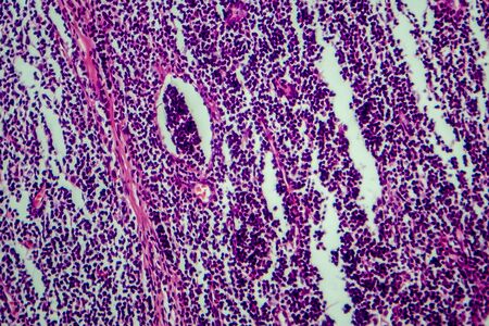 Hodgkins lymphoma, light micrograph, photo under microscopeの写真素材