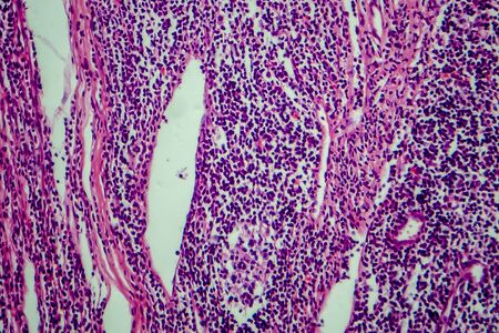 Hodgkins lymphoma, light micrograph, photo under microscopeの写真素材