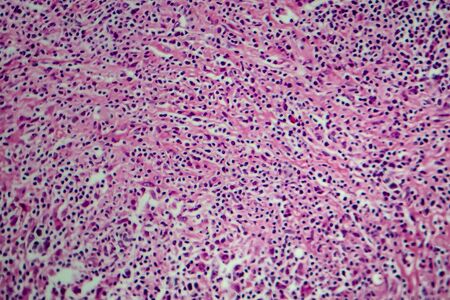 Hodgkin's lymphoma, light micrograph, photo under microscopeの写真素材