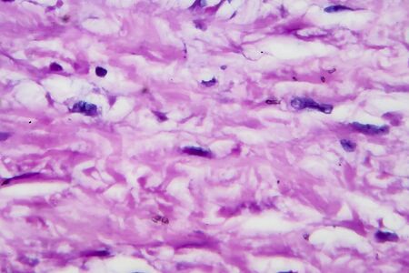 Hodgkins lymphoma, light micrograph, photo under microscope. High magnificationの写真素材