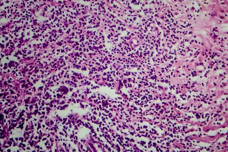 Hodgkins lymphoma, light micrograph, photo under microscopeの写真素材