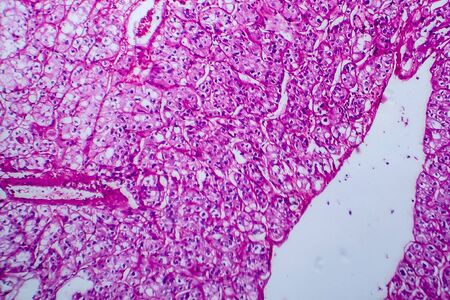Renal cell carcinoma, light micrograph, photo under microscope