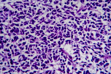 Wilms tumor, or nephroblastoma, light micrograph, photo under microscopeの写真素材