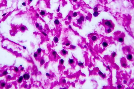 Renal cell carcinoma, light micrograph, photo under microscope. High magnificationの写真素材