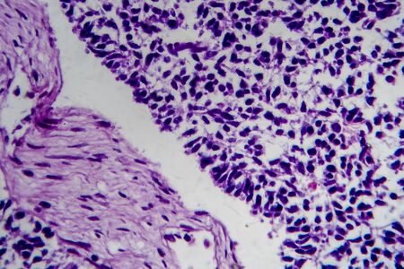 Wilms tumor, or nephroblastoma, light micrograph, photo under microscopeの写真素材