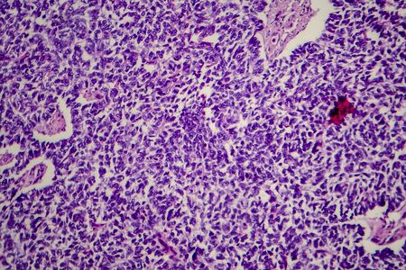 Wilms tumor, or nephroblastoma, light micrograph, photo under microscopeの写真素材