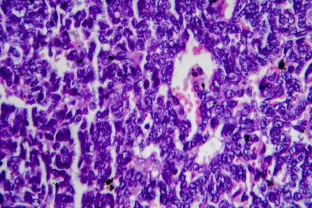 Wilms tumor, or nephroblastoma, light micrograph, photo under microscope. High magnificationの写真素材
