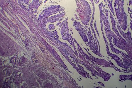 Bladder transitional cell carcinoma, light micrograph, photo under microscope