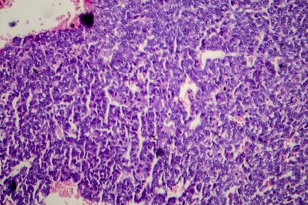 Wilms tumor, or nephroblastoma, light micrograph, photo under microscopeの写真素材