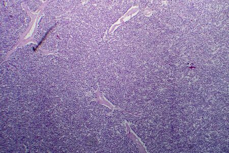 Wilms tumor, or nephroblastoma, light micrograph, photo under microscope