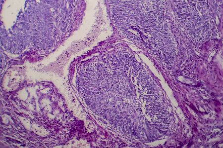 Bladder transitional cell carcinoma, light micrograph, photo under microscopeの写真素材