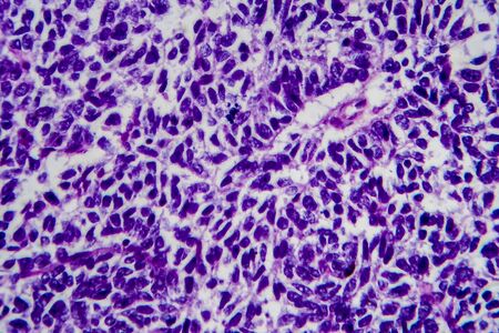 Wilms tumor, or nephroblastoma, light micrograph, photo under microscope. High magnificationの写真素材