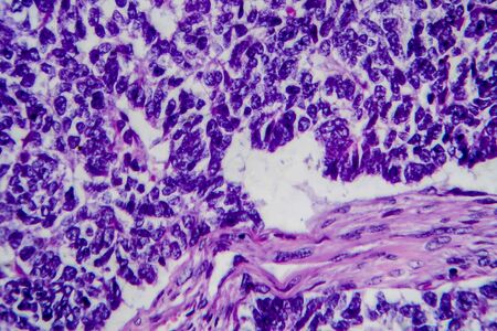 Wilms tumor, or nephroblastoma, light micrograph, photo under microscope. High magnification