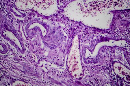 Bladder transitional cell carcinoma, light micrograph, photo under microscopeの写真素材