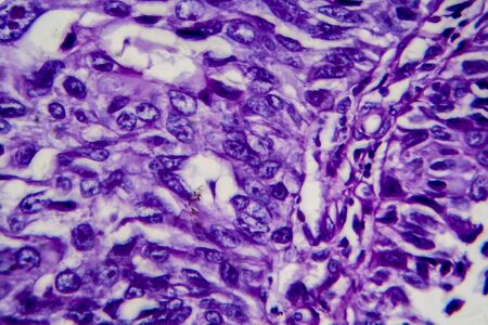 Bladder transitional cell carcinoma, light micrograph, photo under microscope. High magnificationの写真素材