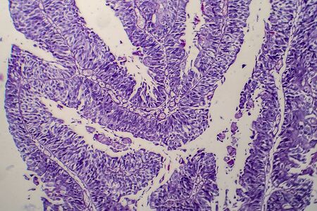 Bladder transitional cell carcinoma, light micrograph, photo under microscopeの写真素材