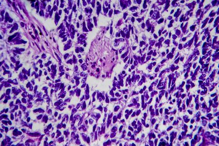Wilms tumor, or nephroblastoma, light micrograph, photo under microscope. High magnificationの写真素材