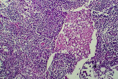 Hodgkins lymphoma, light micrograph, photo under microscopeの写真素材