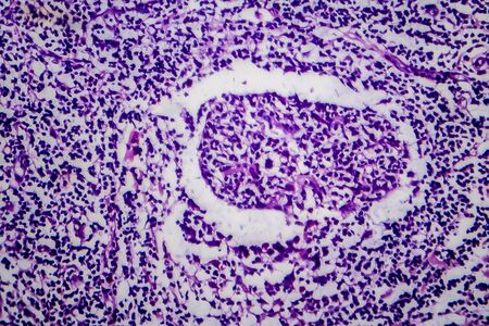 Hodgkins lymphoma, light micrograph, photo under microscopeの写真素材