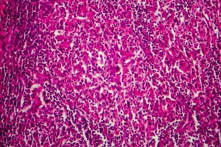 Non-Hodgkins lymphoma, light micrograph, photo under microscopeの写真素材
