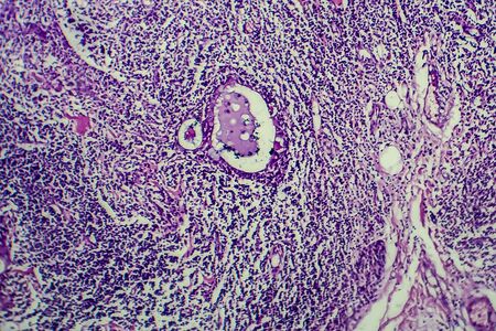 Hodgkins lymphoma, light micrograph, photo under microscopeの写真素材