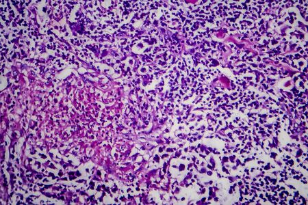 Hodgkins lymphoma, light micrograph, photo under microscopeの写真素材
