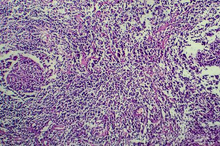 Hodgkins lymphoma, light micrograph, photo under microscopeの写真素材